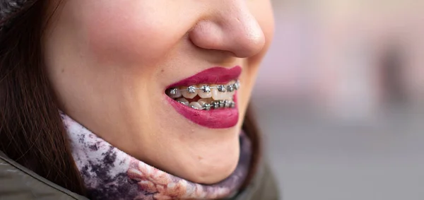 Systém Výztuh Dívčiných Usměvavých Ústech Makrofotografie Zubů Detailní Záběr Rudých — Stock fotografie