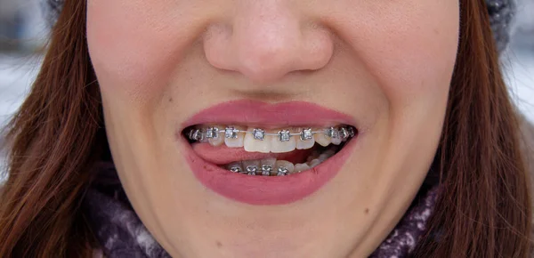 System brasket w uśmiechniętych ustach, makro zdjęcia zębów, zbliżenie ust, — Zdjęcie stockowe