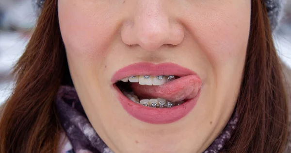 Système de joint dans la bouche souriante, macro photo dents, lèvres gros plan, — Photo