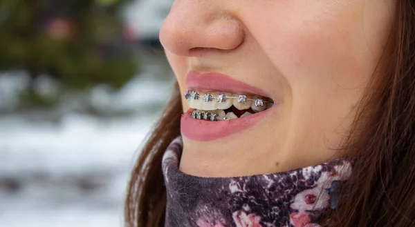 Sistema de férula en la boca sonriente, macrodientes de fotos, labios de cerca, — Foto de Stock