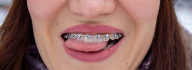 Kız dişlerinde diş telleri gülümseme, makro fotoğraf dişleri, yakın plan dudaklar., 