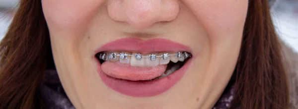 Braces on the girls teeth smiling, macro photo teeth, close-up lips, — Stock Photo, Image