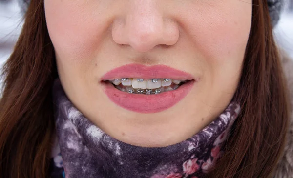 Tirantes en los dientes de las niñas, macro dientes de fotos, labios de cerca, — Foto de Stock