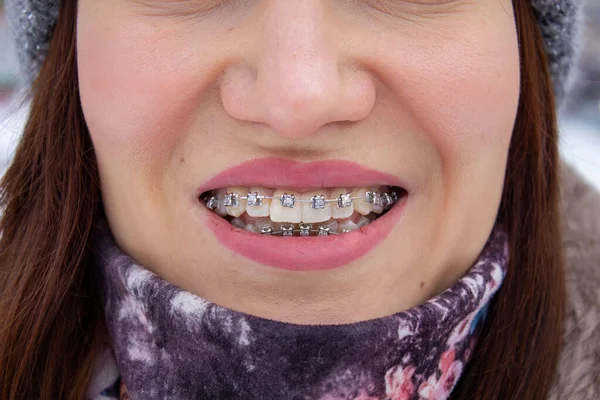 Tirantes en los dientes de las niñas, macro dientes de fotos, labios de cerca, —  Fotos de Stock