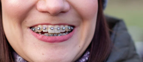 Braces on the girls teeth, macro photo teeth, close-up lips,