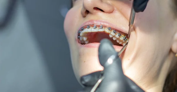 A woman with dental braces visits an orthodontist in the clinic, in a dental chair. during the procedure of installing the arch of braces on the upper and lower teeth. The dentist is wearing gloves and has dental instruments in his hands. The concept