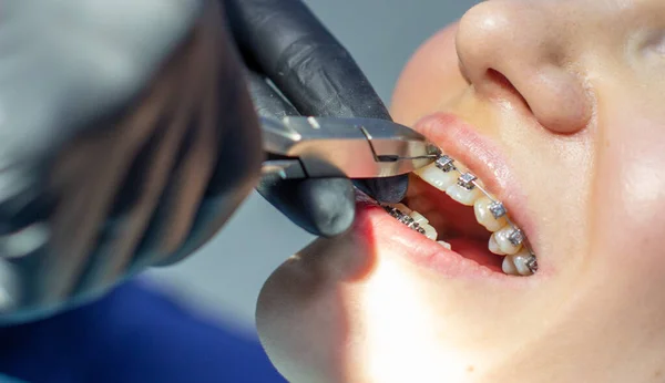 A woman with dental braces visits an orthodontist in the clinic, in a dental chair. during the procedure of installing the arch of braces on the upper and lower teeth. The dentist is wearing gloves and has dental instruments in his hands. The concept