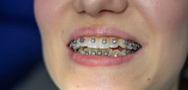 Dişlerinde diş teli olan bir kadın diş hekimi koltuğunda bir dişçiyi ziyaret ediyor. Üst ve alt dişlere tel kemeri yerleştirme işlemi sırasında. Kız gülümsüyor. Diş hekimliği kavramı.