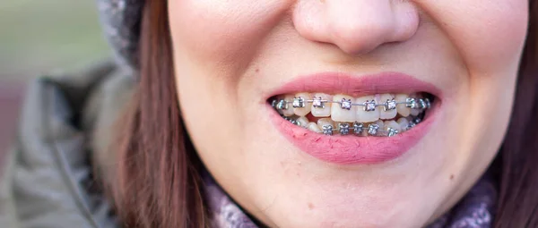 Sistema Brasket Nella Bocca Sorridente Una Ragazza Macrofotografia Dei Denti — Foto Stock