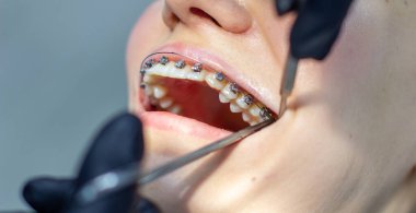 Diş teli takan bir kadın, dişçi koltuğunda, klinikteki bir dişçiyi ziyaret ediyor. Üst ve alt dişlere tel kemeri yerleştirme işlemi sırasında. Diş hekimi eldiven takıyor ve ellerinde diş aletleri var. Konsept