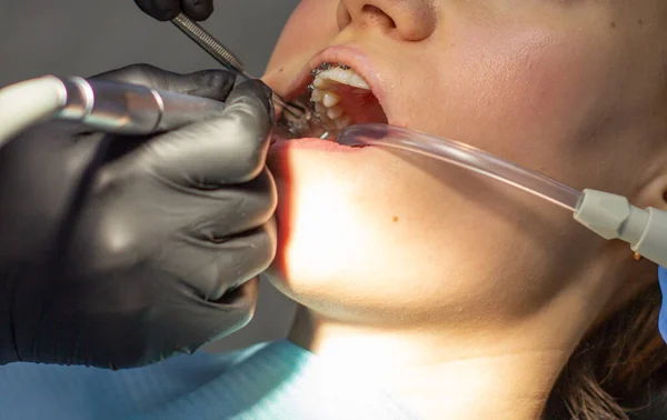A woman with dental braces visits an orthodontist at the clinic. in the dental chair during the procedure of installing braces on the upper and lower teeth. Dentist and assistant work together, they have dental instruments in their hands. concept of