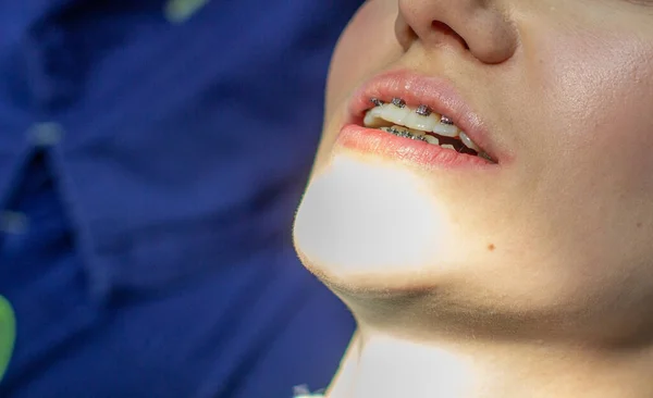 Dişlerinde Diş Teli Olan Bir Kadın Diş Hekimi Koltuğunda Bir — Stok fotoğraf