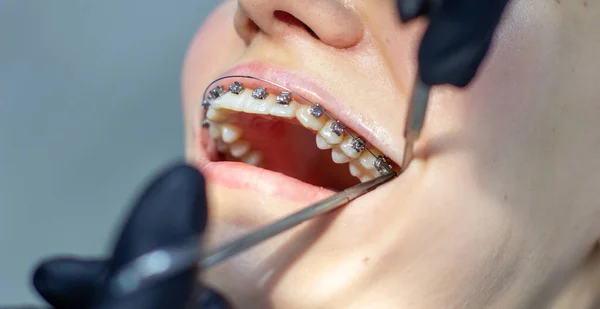 Diş teli takan bir kadın, dişçi koltuğunda, klinikteki bir dişçiyi ziyaret ediyor. Üst ve alt dişlere tel kemeri yerleştirme işlemi sırasında. Diş hekimi eldiven takıyor ve ellerinde diş aletleri var. Konsept