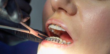 Diş teli takan bir kadın dişçi koltuğunda bir dişçiyi ziyaret ediyor. Alt dişlere tel kemeri taktırma işlemi sırasında. Diş hekimi eldiven takıyor ve elinde bir çift pens tutuyor.. 