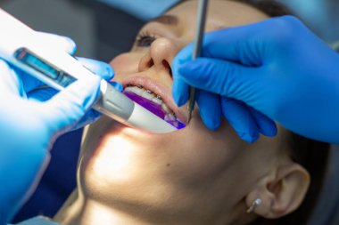 Diş teli takan bir kadın klinikteki bir ortodontiste gidiyor. Üst ve alt dişlere diş teli taktırma işlemi sırasında dişçi koltuğunda. Dişçi ve asistan birlikte çalışıyor, ellerinde diş aletleri var. konsept 