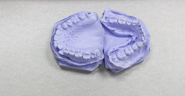 牙科医生的牙膏铸成的牙膏 安装托架时的下颚和牙齿模型 — 图库照片