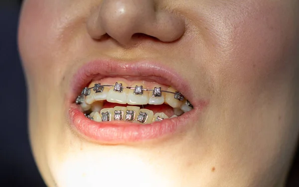 Žena Rovnátky Zubech Navštíví Zubaře Zubním Křesle Během Instalace Oblouku — Stock fotografie