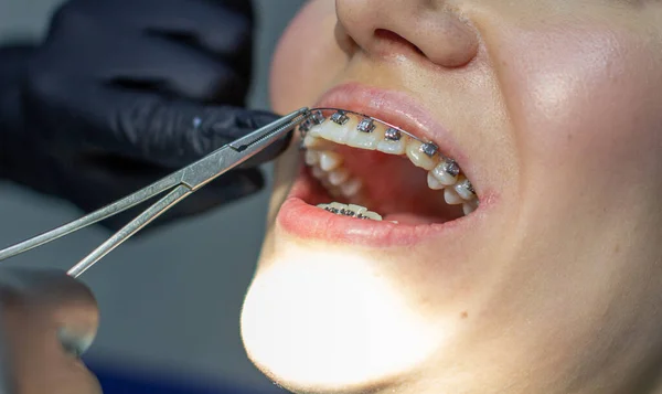 Diş teli takan bir kadın, dişçi koltuğunda, klinikteki bir dişçiyi ziyaret ediyor. Üst ve alt dişlere tel kemeri yerleştirme işlemi sırasında. Diş hekimi eldiven takıyor ve ellerinde diş aletleri var. Konsept
