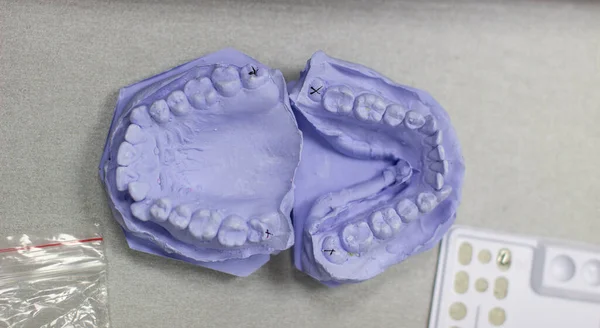 Molde Gesso Dentes Gesso Ortodontista Modelo Mandíbula Dentes Para Instalação — Fotografia de Stock