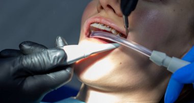 Diş teli takan bir kadın klinikteki bir ortodontiste gidiyor. Üst ve alt dişlere diş teli taktırma işlemi sırasında dişçi koltuğunda. Dişçi ve asistan birlikte çalışıyor, ellerinde diş aletleri var. konsept 
