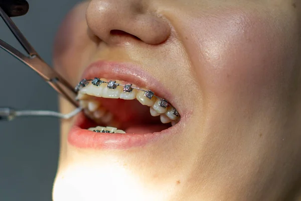 Žena Zubními Rovnátky Navštěvuje Zubaře Klinice Zubním Křesle Během Instalace — Stock fotografie