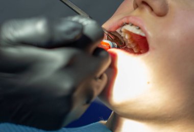 Diş teli takan bir kadın dişçi koltuğunda bir dişçiyi ziyaret ediyor. Alt dişlere tel kemeri taktırma işlemi sırasında. Diş hekimi eldiven takıyor ve elinde bir çift pens tutuyor.. 