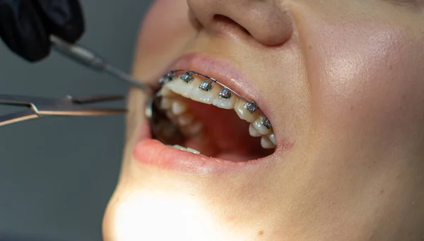 Een Vrouw Met Een Tandbeugel Bezoekt Een Orthodontist Kliniek Een — Stockfoto