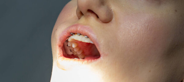 A woman at a dentists appointment to replace arches with braces.