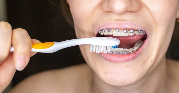 Girl with braces on her teeth brushing her teeth with a toothbrush, close-up. Dental and oral care. Braces for leveling teeth