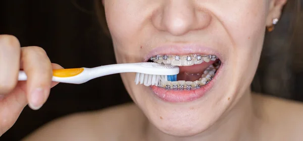 Girl with braces on her teeth brushing her teeth with a toothbrush, close-up. Dental and oral care. Braces for leveling teeth