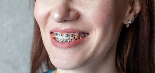 Sistema Brasket Nella Bocca Sorridente Una Ragazza Macrofotografia Dei Denti — Foto Stock