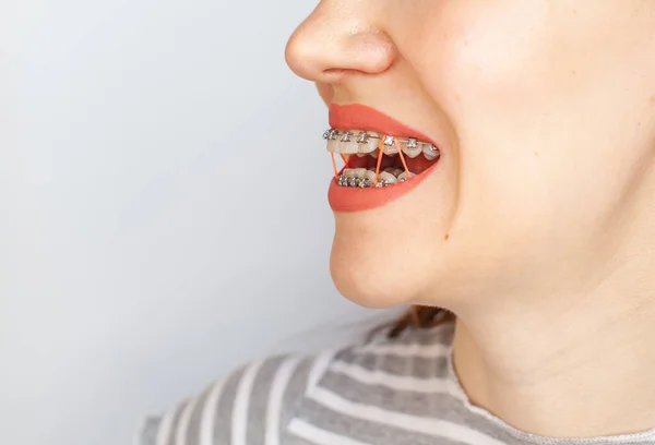 站在一个女孩微笑的嘴上 牙齿和嘴唇的特写照片 用牙套磨牙 在弹性带的牙齿上 用来紧咬牙齿 照片背景为浅色固体 — 图库照片