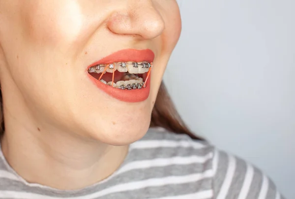 女の子の笑顔の口の中にブレース 歯と唇のクローズアップ写真 ブレースからの滑らかな歯 歯を引き締めるための弾性バンドの歯に 光の固い背景の写真 — ストック写真