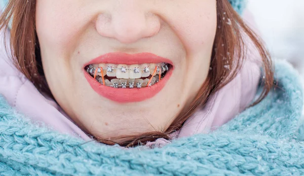 Chica Tiene Aparatos Ortopédicos Los Dientes Una Chica Invierno Calle —  Fotos de Stock