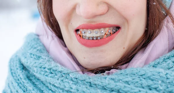 Rapariga Tem Aparelho Nos Dentes Uma Menina Inverno Rua Sorrisos — Fotografia de Stock
