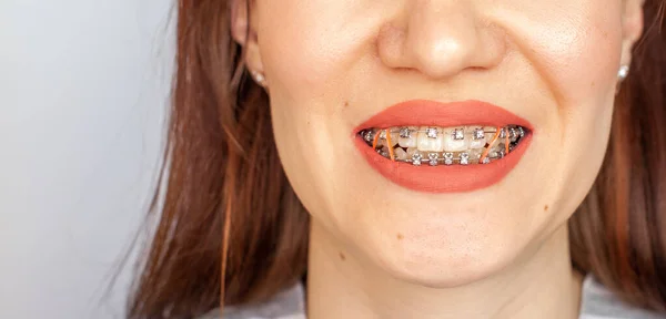 Aparelhos Boca Sorridente Uma Rapariga Close Fotos Dentes Lábios Dentes — Fotografia de Stock