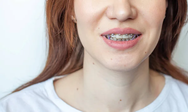 Aparelhos na boca sorridente de uma rapariga. Dentes lisos de aparelhos. — Fotografia de Stock