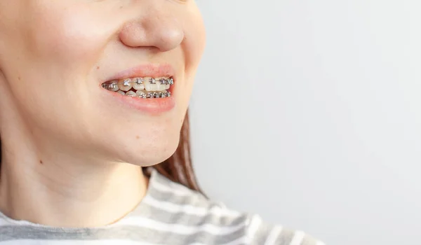 Aparelhos na boca sorridente de uma rapariga. Dentes lisos de aparelhos. — Fotografia de Stock