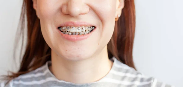 Szelki w uśmiechniętych ustach dziewczyny. Gładkie zęby z aparatu na zęby. — Zdjęcie stockowe