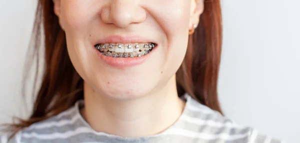 Braces in the smiling mouth of a girl. Smooth teeth from braces.