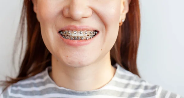 Håll i en flickas leende mun. Mjuka tänder från tandställning. — Stockfoto