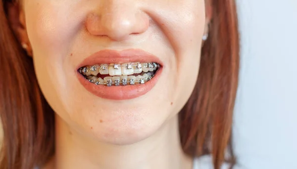 女の子の笑顔の口の中にブレース 歯と唇のクローズアップ写真 ブレースからの滑らかな歯 歯を引き締めるための弾性バンドの歯に 光の固い背景の写真 — ストック写真