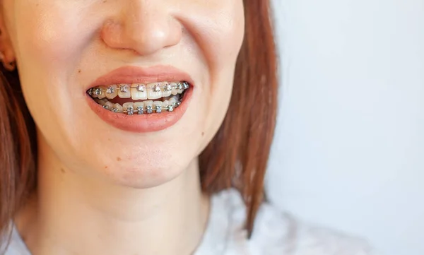 Braces Smiling Mouth Girl Close Photos Teeth Lips Smooth Teeth — Stock Photo, Image
