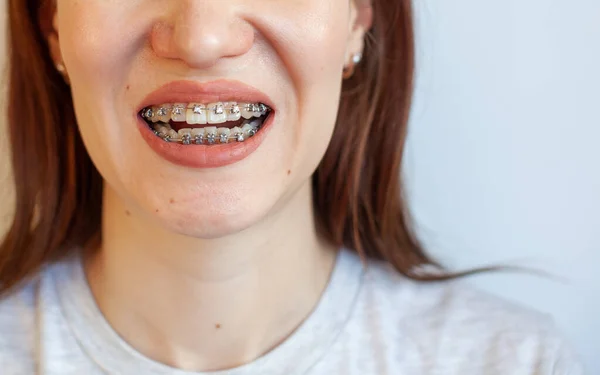 Rovnátka Usměvavé Tlamě Dívky Detailní Fotky Zubů Rtů Jemné Zuby — Stock fotografie