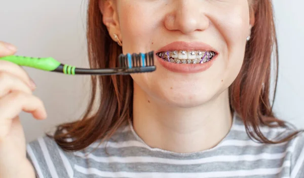 Tirantes Boca Sonriente Una Chica Fotos Cerca Dientes Labios Dientes — Foto de Stock