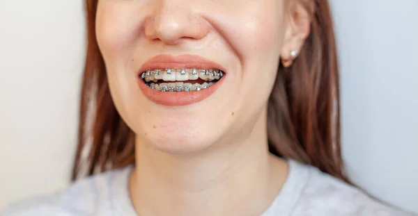 Tirantes Boca Sonriente Una Chica Fotos Cerca Dientes Labios Dientes — Foto de Stock