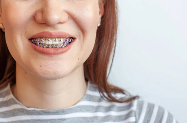 Szelki Uśmiechniętych Ustach Dziewczyny Zbliżenie Zdjęcia Zębów Ust Gładkie Zęby — Zdjęcie stockowe
