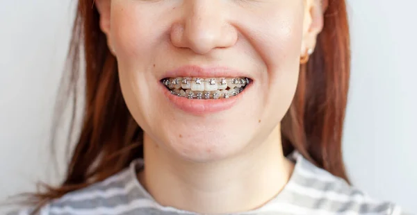 Aparelhos Boca Sorridente Uma Rapariga Close Fotos Dentes Lábios Dentes — Fotografia de Stock