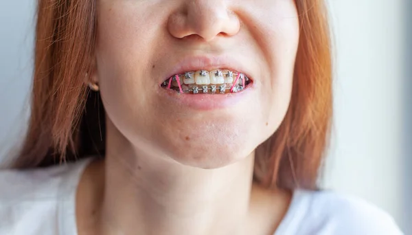 Zahnspange Lächelnden Mund Eines Mädchens Nahaufnahmen Von Zähnen Und Lippen — Stockfoto