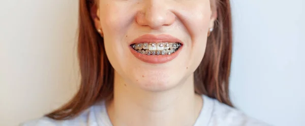 Braces Dans Bouche Souriante Une Fille Photos Rapprochées Des Dents — Photo